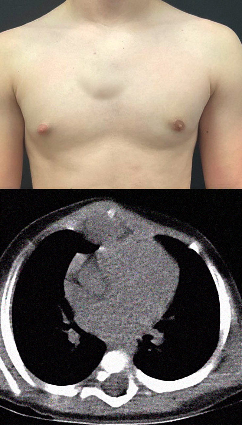 Chest wall tumors