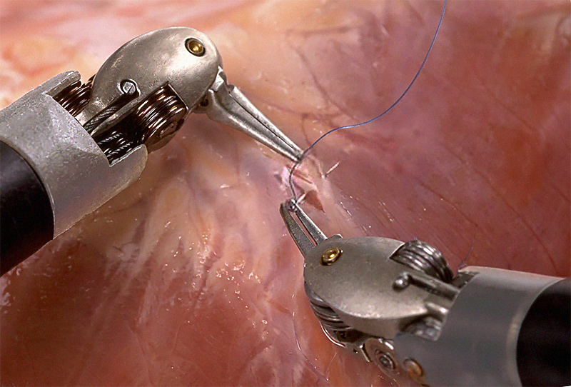 da Vinci Surgery System - Robotics precision