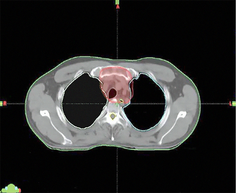 Radiotherapy for mediastinal tumors