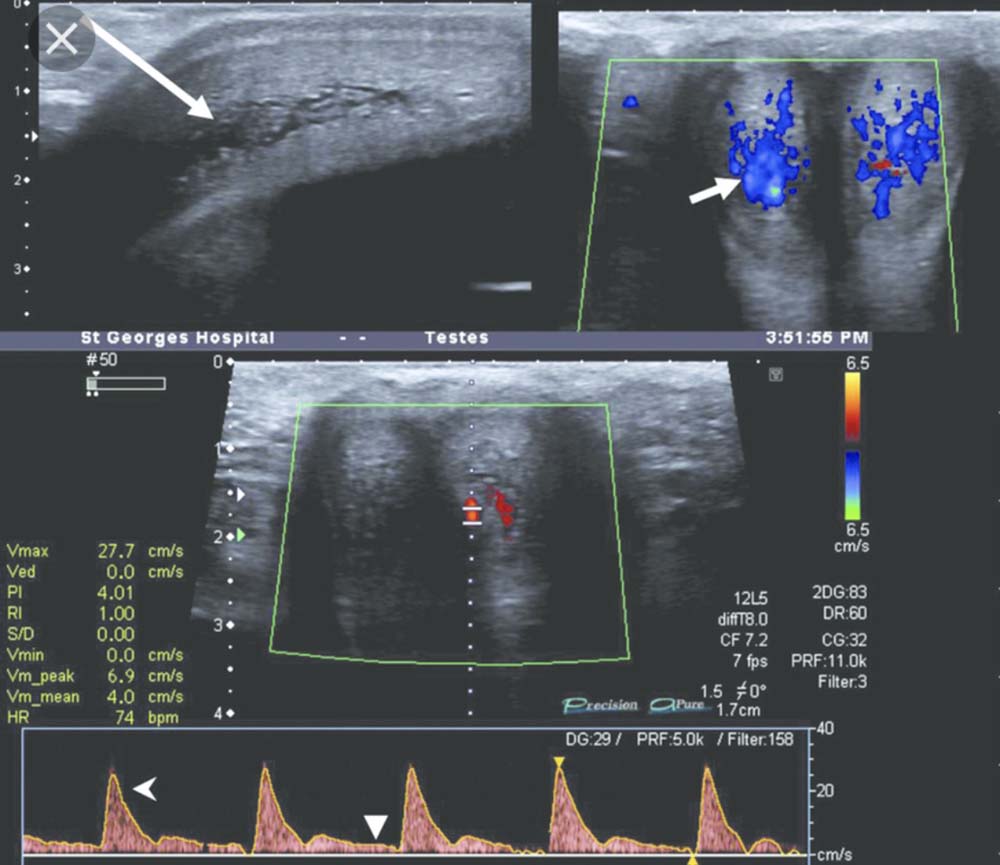 erectile dysfunction ultrasound flow penile diagnosis