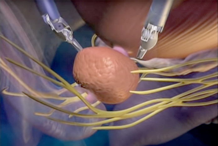 saltet Gnide skillevæg Robotic Prostate Cancer Surgery | Saint John's Cancer Institute