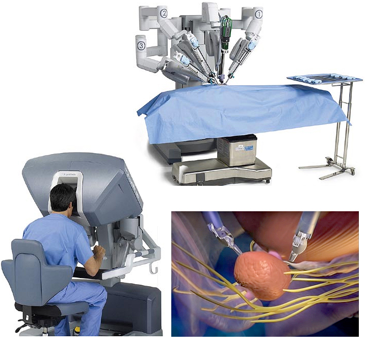 Robotic Urologic Reconstruction & UPJ Treatment Saint John’s Cancer