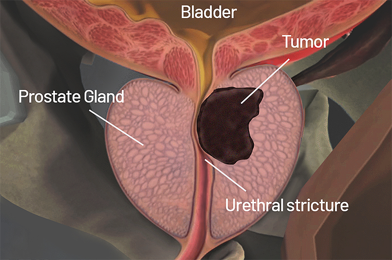 Prostate gland cancerous tumor