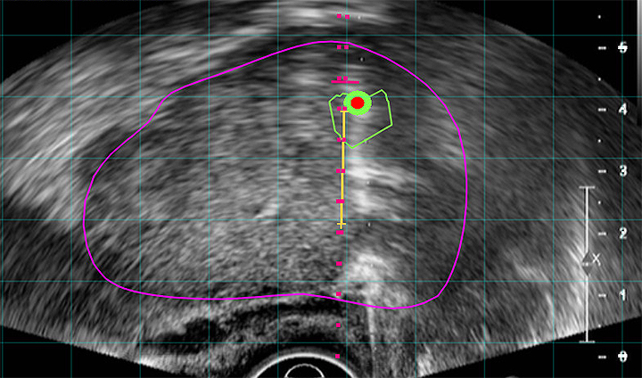 Targeted MRI-Ultrasound Fusion Biopsy