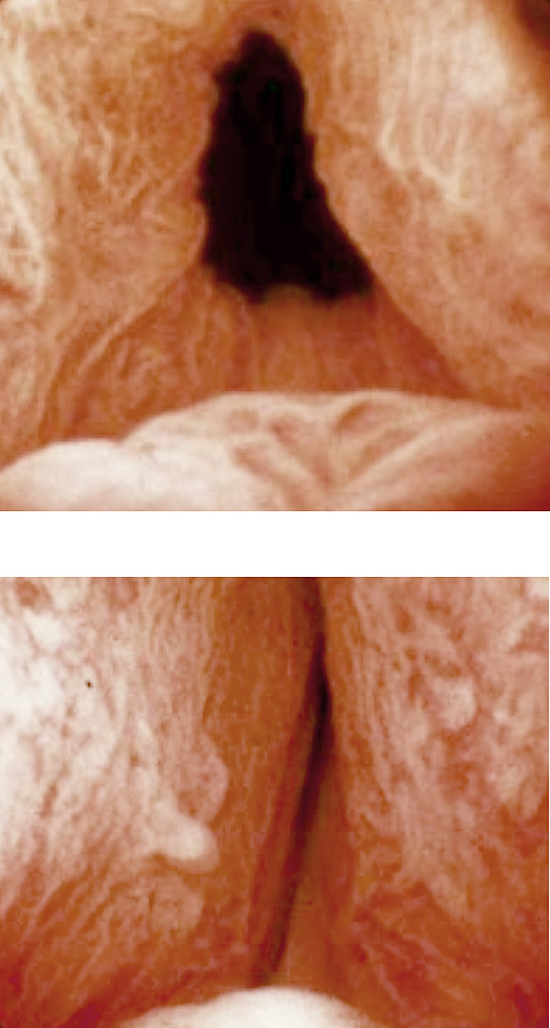 cyctoscopy - blocked urethra