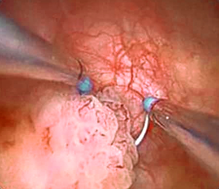 Cystoscopy - bladder cancer