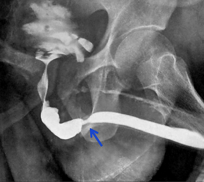 Retrograde Pyelogram - Urethral obstruction