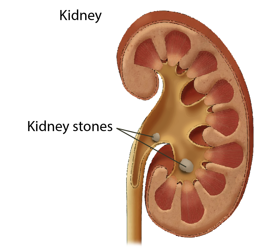Kidney Stones, Kidney Stone Symptoms, Nephrolithiasis