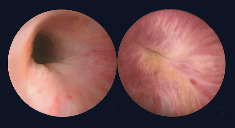 artificial sphincter treatment results for SUI