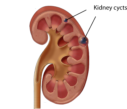 Cycts in the kidney