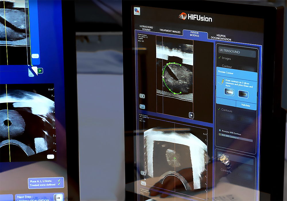 HIFUsion - Integrated Ultrasound and MRI imaging - Focal One Therapy