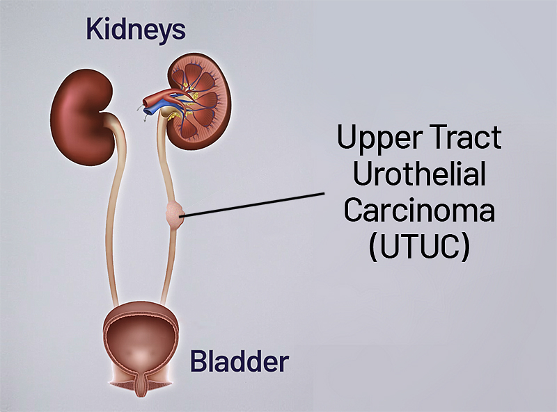 Upper Tract Urothelial Carcinoma (UTUC) - Saint John's Cancer Institute