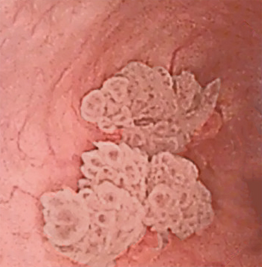 Ureteroscopy with biopsy