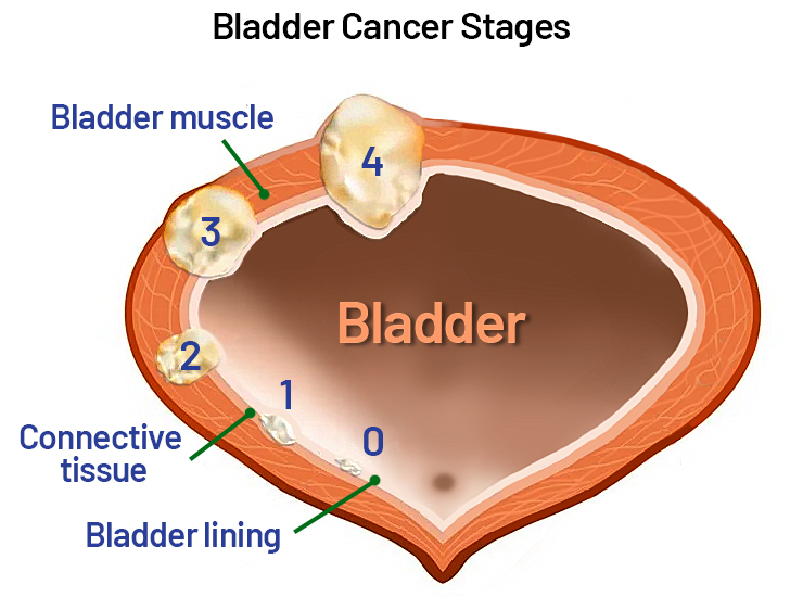 Bladder Cancer Stages - Saint John's Cancer Institute