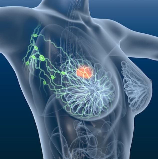 健康・医学 Breast Cancer Triple-Negative Breast Cancer | Saint John's Cancer Institute