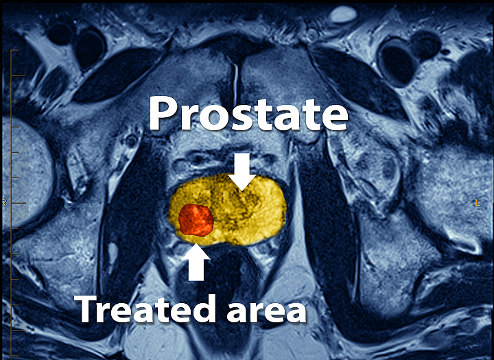 High Intensity Focused Ultrasound for Prostate Cancer - Saint John's Cancer Institute