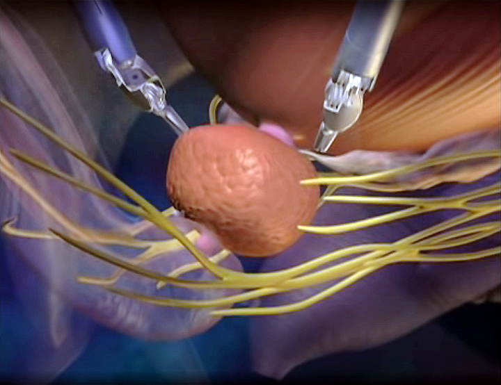 Prostatectomy using the da Vinci Robotic Surgery System - Saint John's Cancer Institute