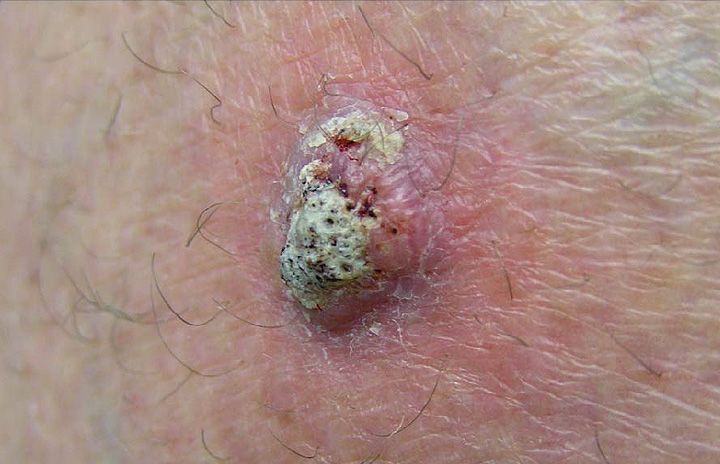 Squamous Cell Carcinoma of the Skin