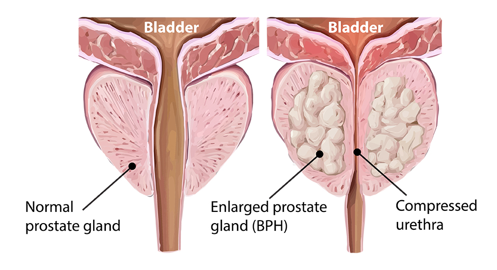 Enlarged-prostate-gland-BPH