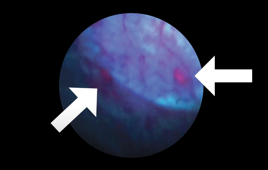 Blue light cystoscopy - Saint John's Cancer Institute