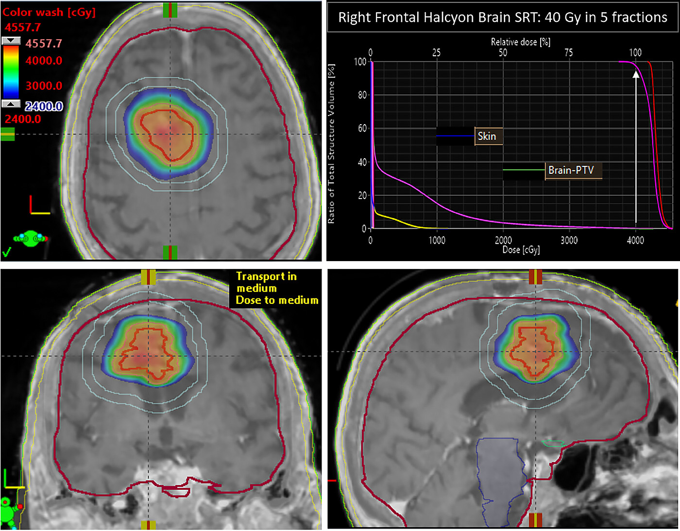 Stereotactic radiosurgery