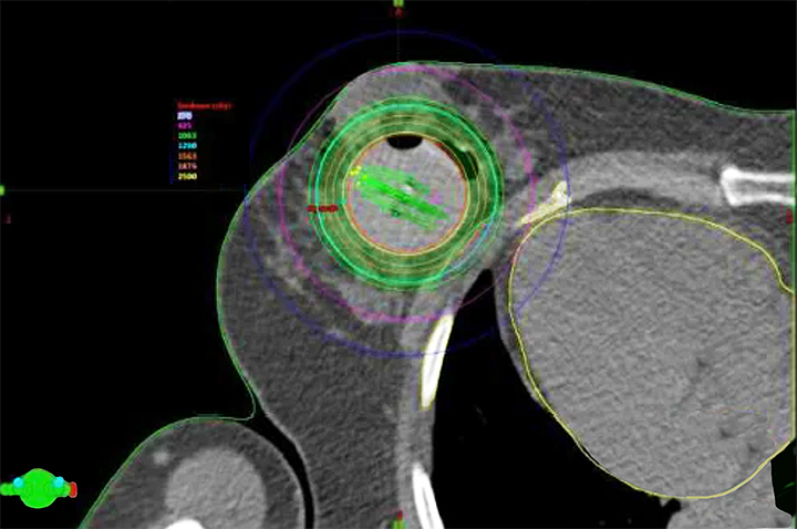 Intraoperative Radiation Therapy (IORT)